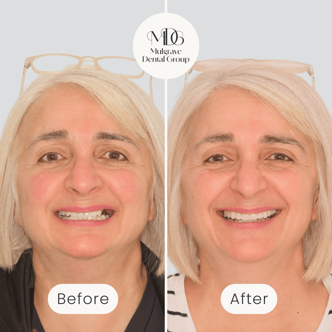 Anna - Veneers & Implants-1