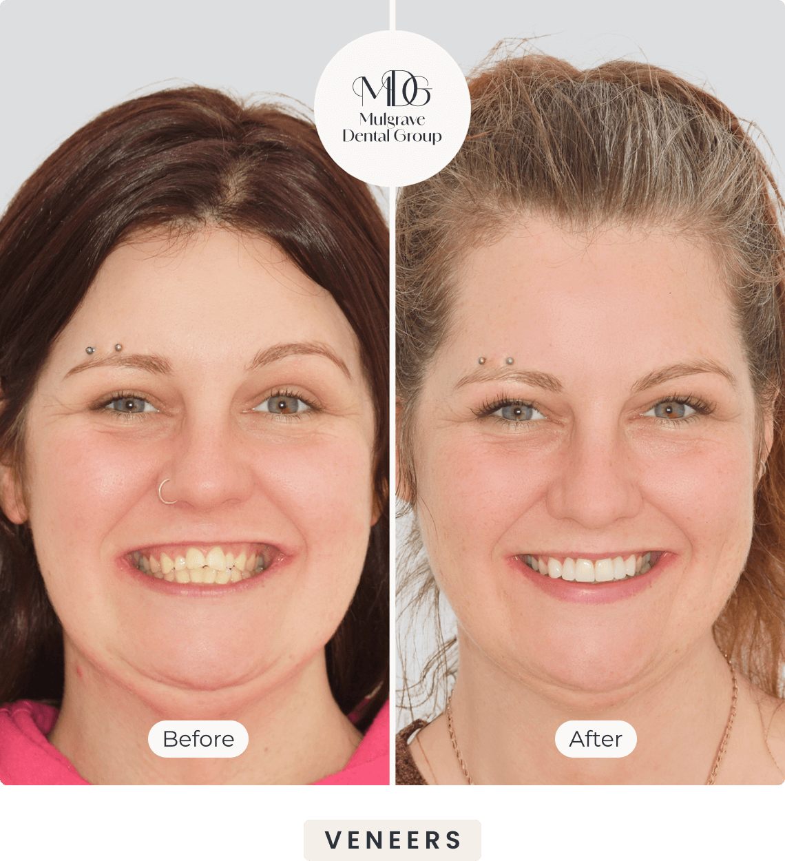 Before & After Veneers Patient