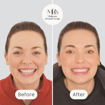 Mulgrave Dental Group patient before veneers, with worn, slightly crooked teeth, and after veneers, with a dazzling perfect smile.