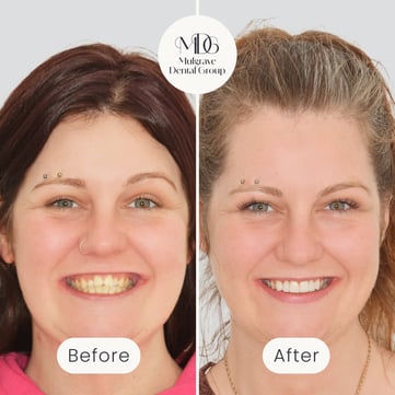 Mulgrave Dental Group patient before veneers, showing discoloured and crooked teeth, and after veneers, with a perfectly aligned and whiter smile.