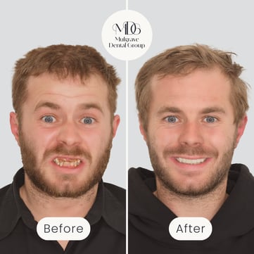 Jordan - Veneers & Implants-1