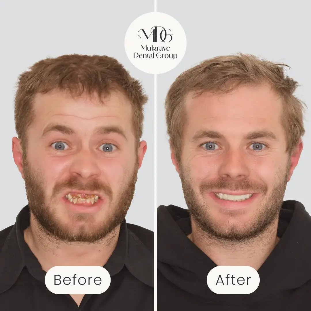 Jordan - Veneers & Implants