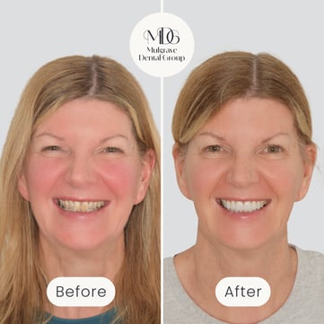 Mulgrave Dental Group patient before veneers, showing discoloured teeth, and after veneers, with a whiter smile.