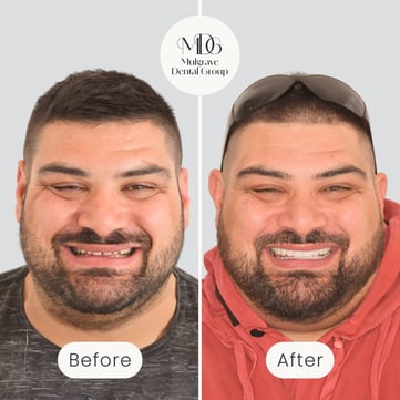 Mulgrave Dental Group patient before veneers, with some gaps between the teeth, and after veneers, with a perfectly aligned and whiter smile.
