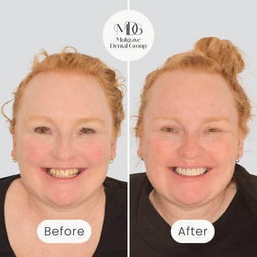 Mulgrave Dental Group patient before veneers, with crooked and discoloured teeth, and after veneers, with a beautifully aligned and whiter smile.