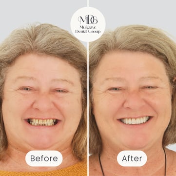 Mulgrave Dental Group patient before veneers, with discoloured teeth, and after veneers, with a natural-looking, whiter smile.